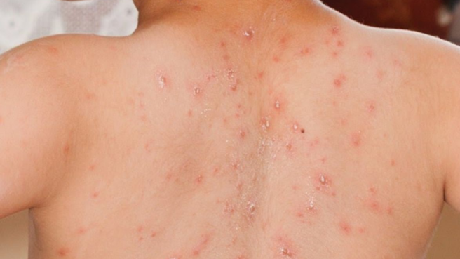 Kasus campak di Indonesia